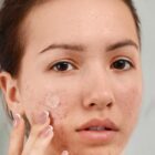 Cara Pakai Acne Patch yang Benar agar Jerawat Cepat Kering