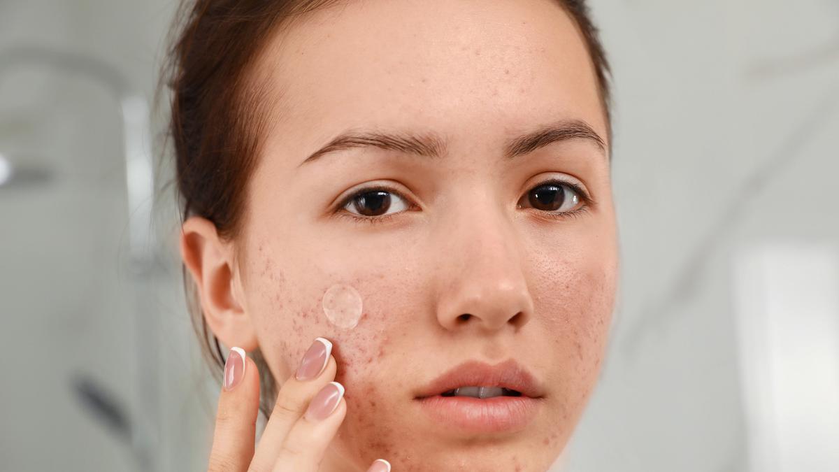 Cara Pakai Acne Patch yang Benar agar Jerawat Cepat Kering
