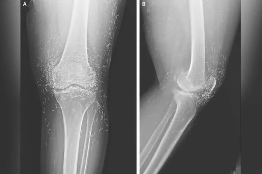 Viral! Dokter Temukan Ratusan Benang Emas Murni di Lutut Wanita Ini