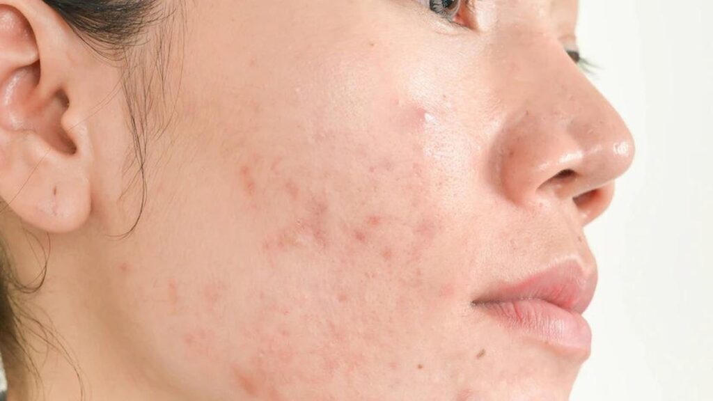 Rahasia Kulit Mulus, Ini Cara Ampuh Menghilangkan Jerawat Merah di Pipi