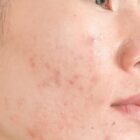 Rahasia Kulit Mulus, Ini Cara Ampuh Menghilangkan Jerawat Merah di Pipi
