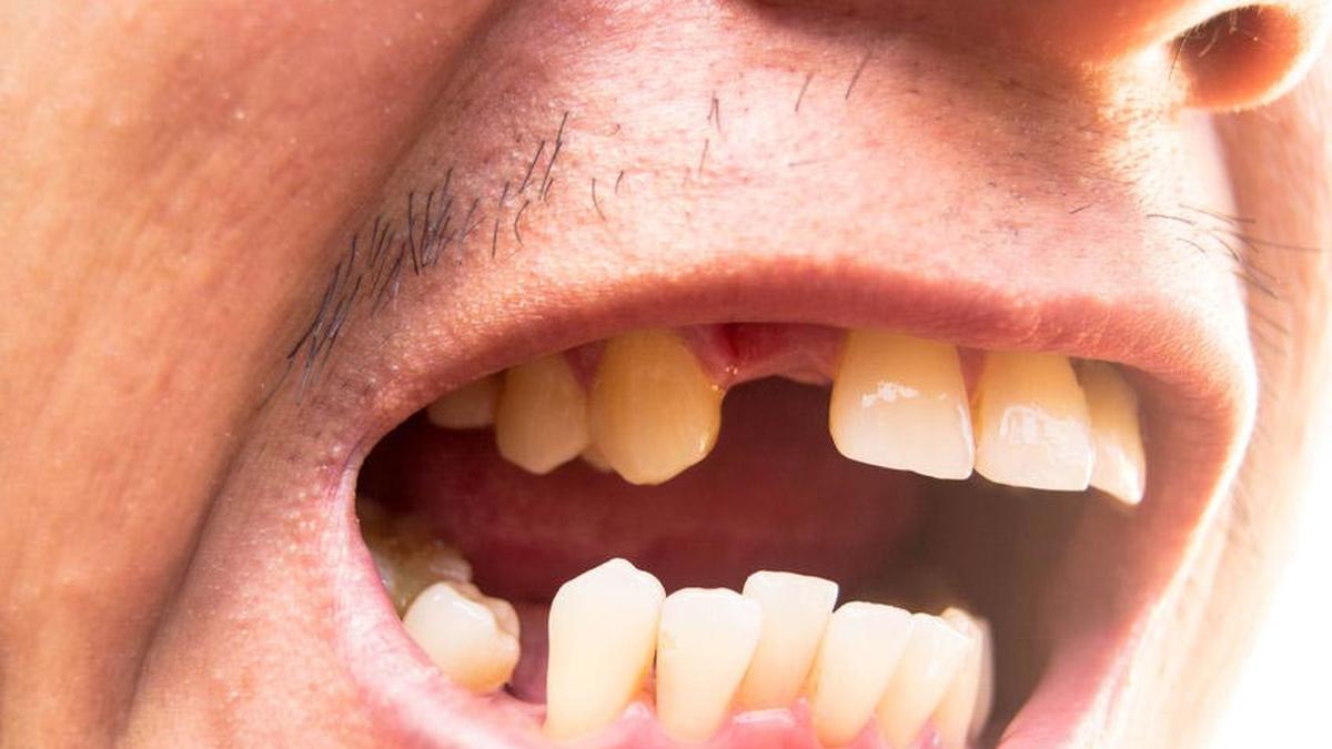 Mimpi Gigi Rontok Semua? Ini Arti dan Makna Tersembunyinya
